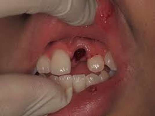 歯損傷