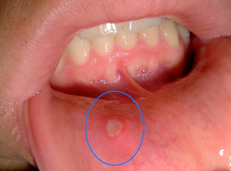 口内炎のサムネイル画像