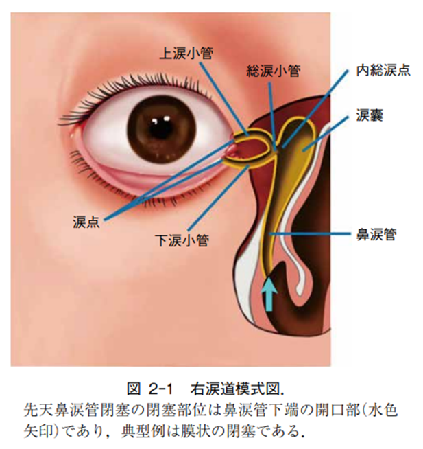 先天性鼻涙管閉塞のサムネイル画像