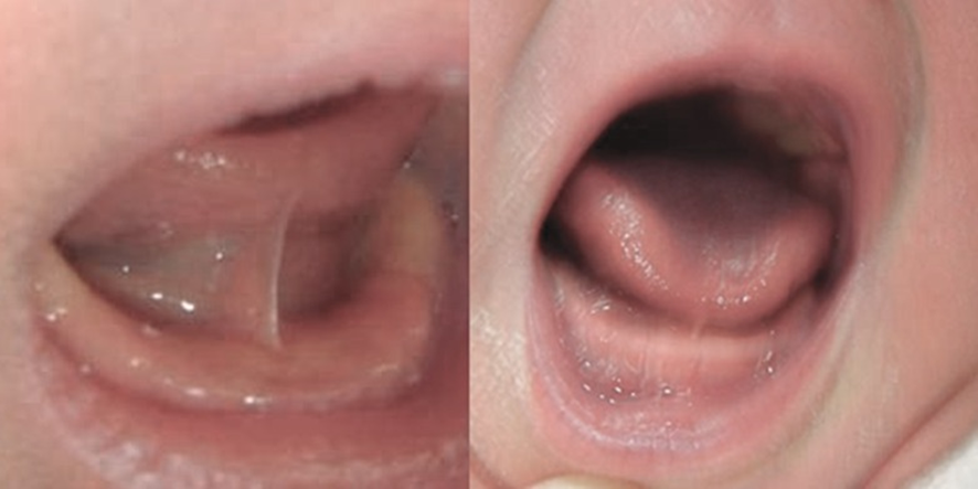 舌小帯短縮症