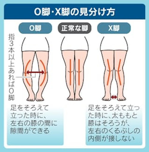 O脚