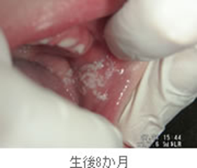 あかちゃんの舌が白い！　鵞口瘡（がこうそう）