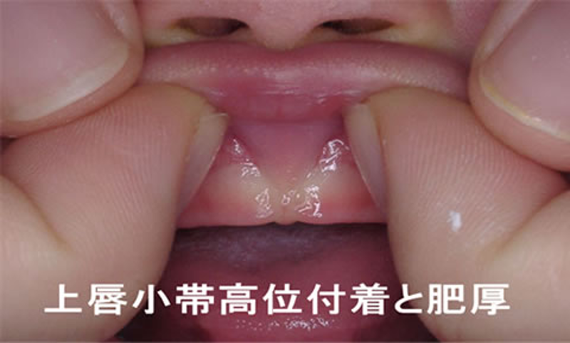 上唇小帯高位付着のサムネイル画像