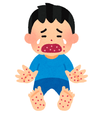 手足口病⑥　発疹は消える？　発疹に対する治療は？　のサムネイル画像