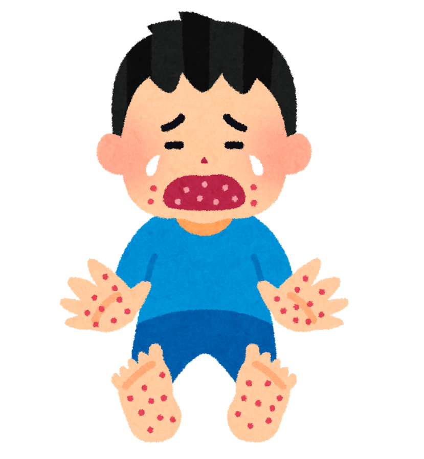 手足口病⑤　発疹からうつる？？？のサムネイル画像